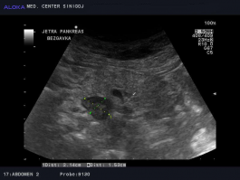 Ultrazvok trebuha - povečana bezgavka ob pankreasu